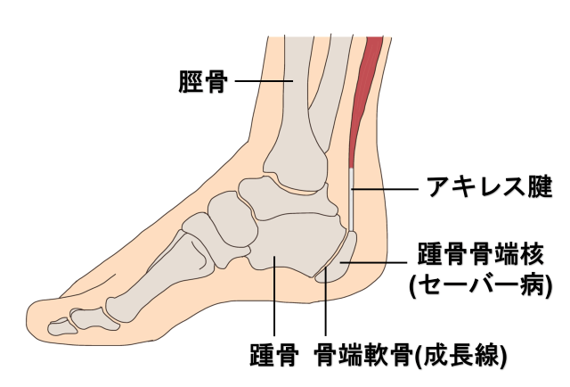 踵骨痛