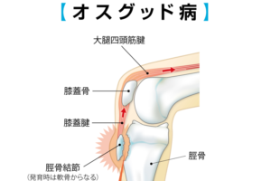 オスグッド・成長痛